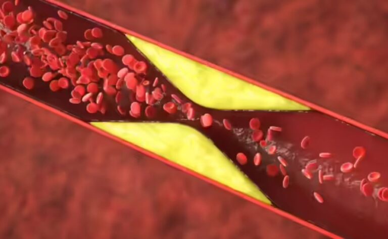 hocala - Dấu hiệu cảnh báo động mạnh bị tắc